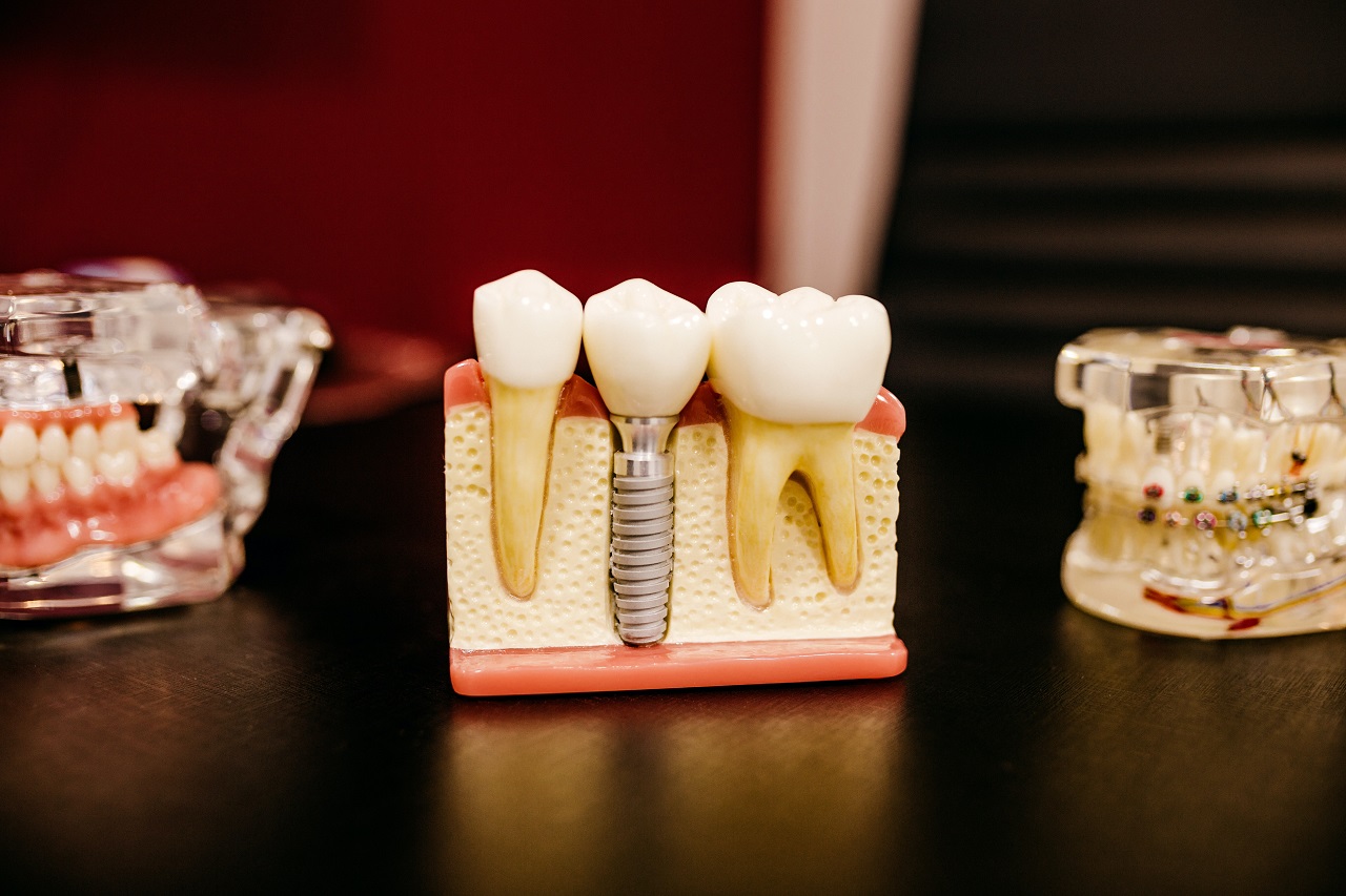 Implanty zębów – z czego mogą być zrobione?