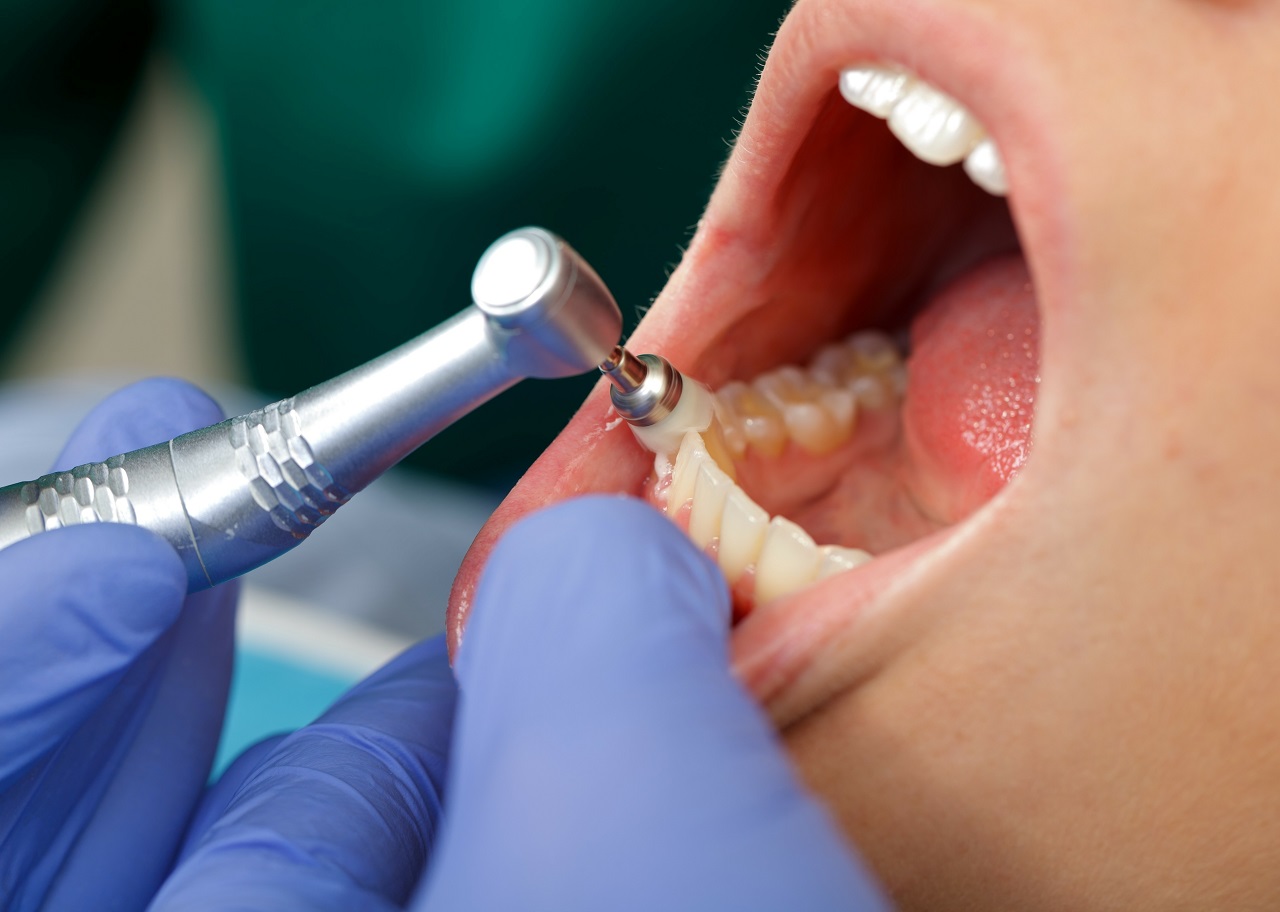 Piaskowania – czym charakteryzuje się ten zabieg stomatologiczny?